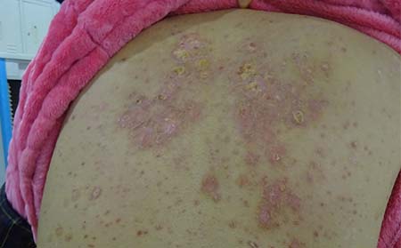 牛皮癣症状表现,牛皮癣有什么征兆